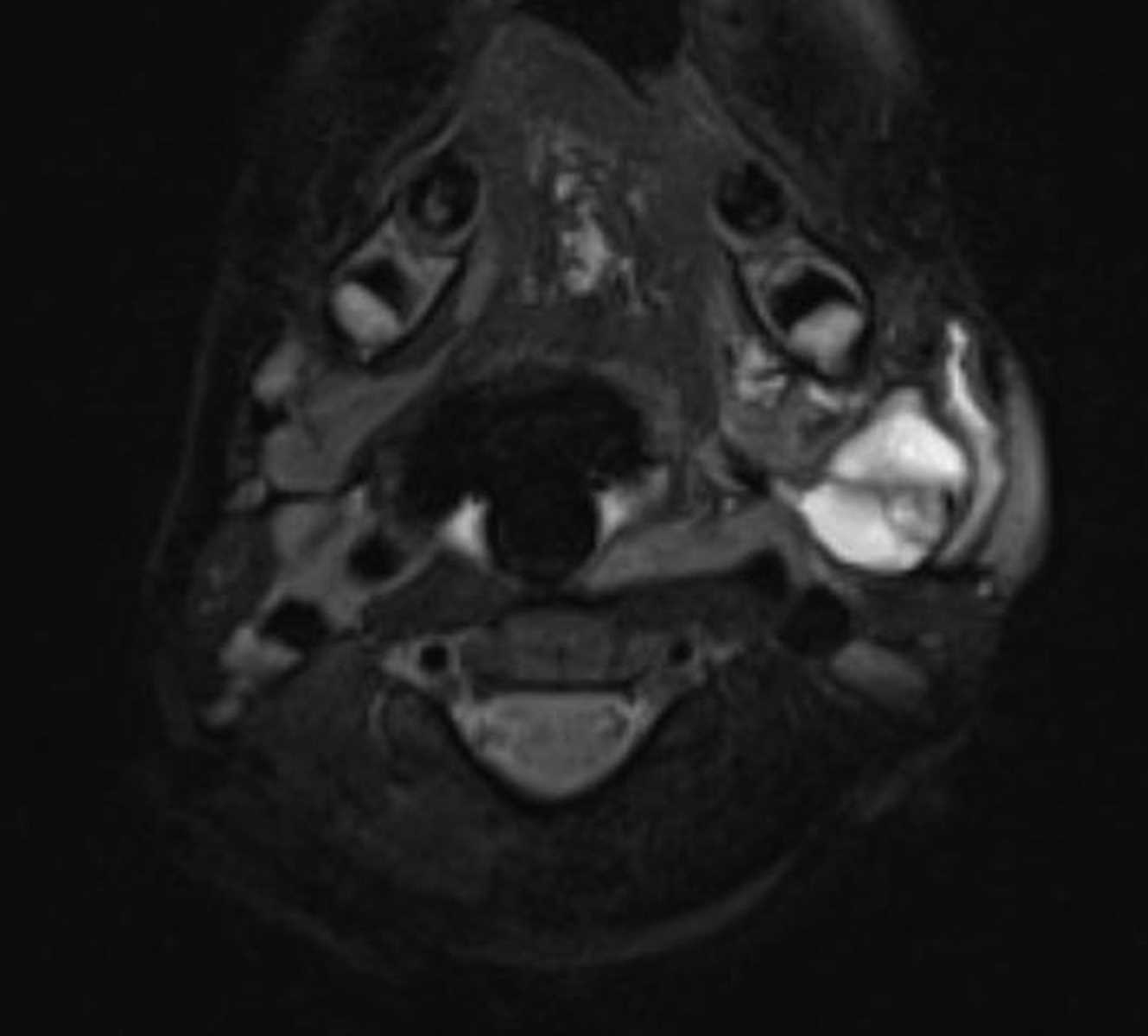 Venolymphatic Malformation - CTisus CT Scan