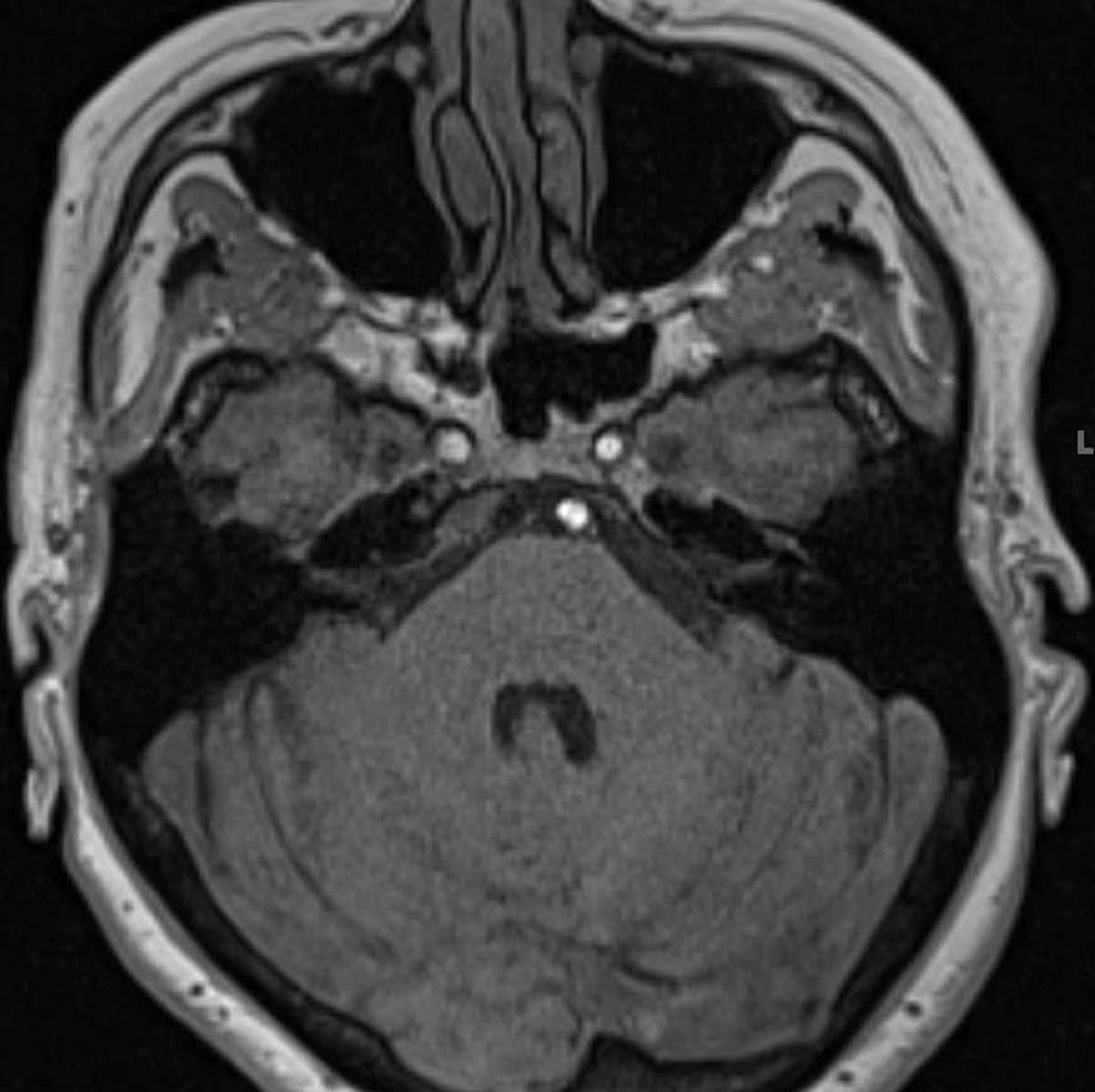 Abducens Nerve Palsy - CTisus CT Scan