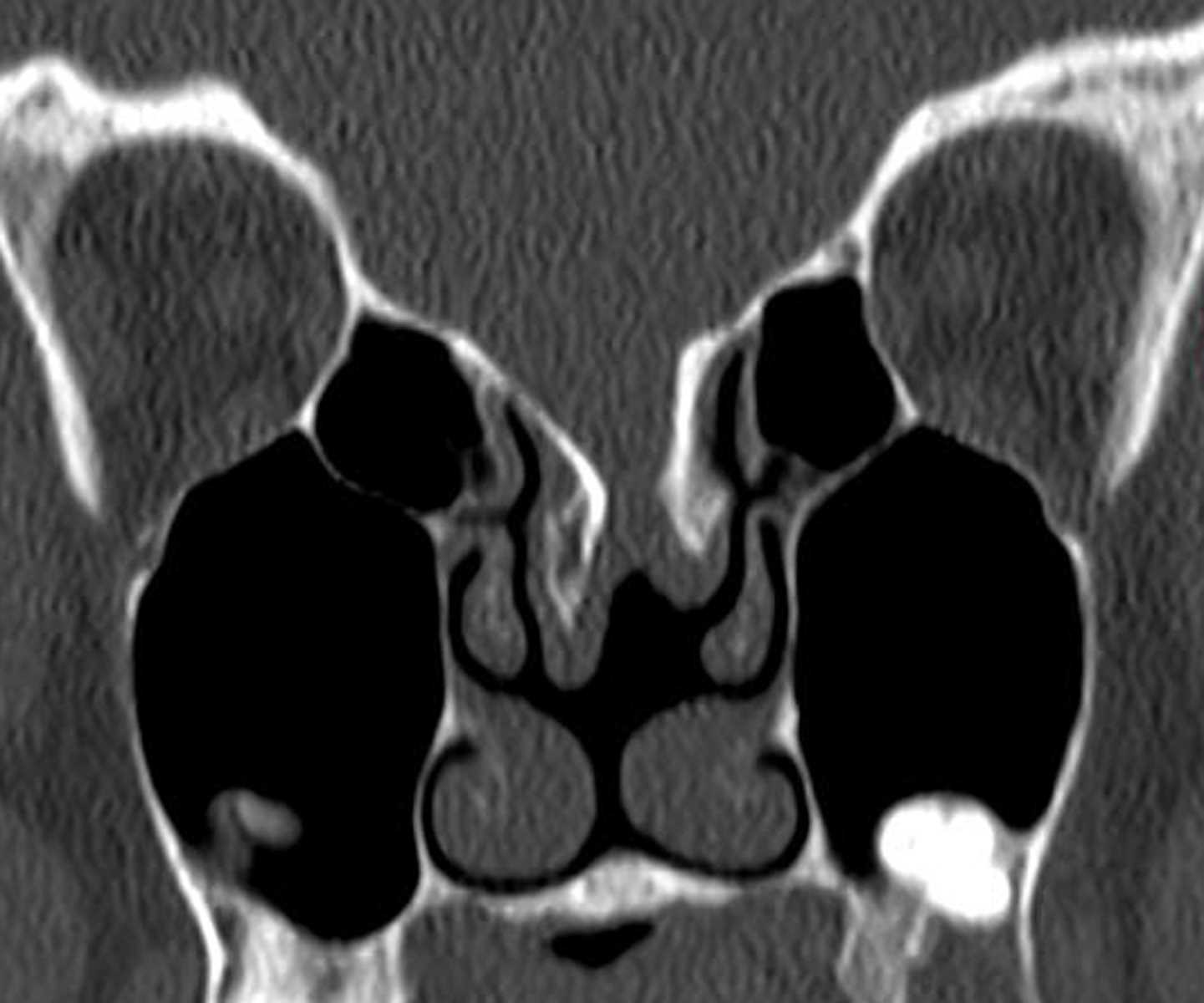 Basal Meningoencephalocele - CTisus CT Scan