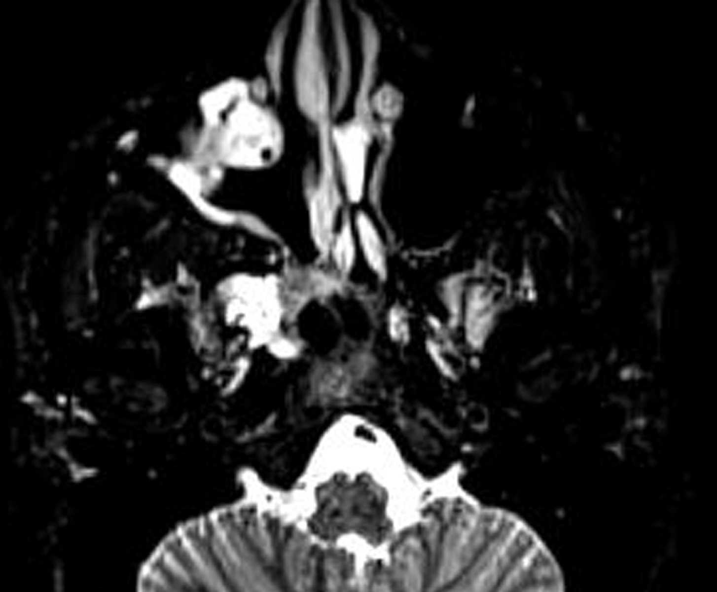 Juvenile Nasopharyngeal Angiofibroma - CTisus CT Scan