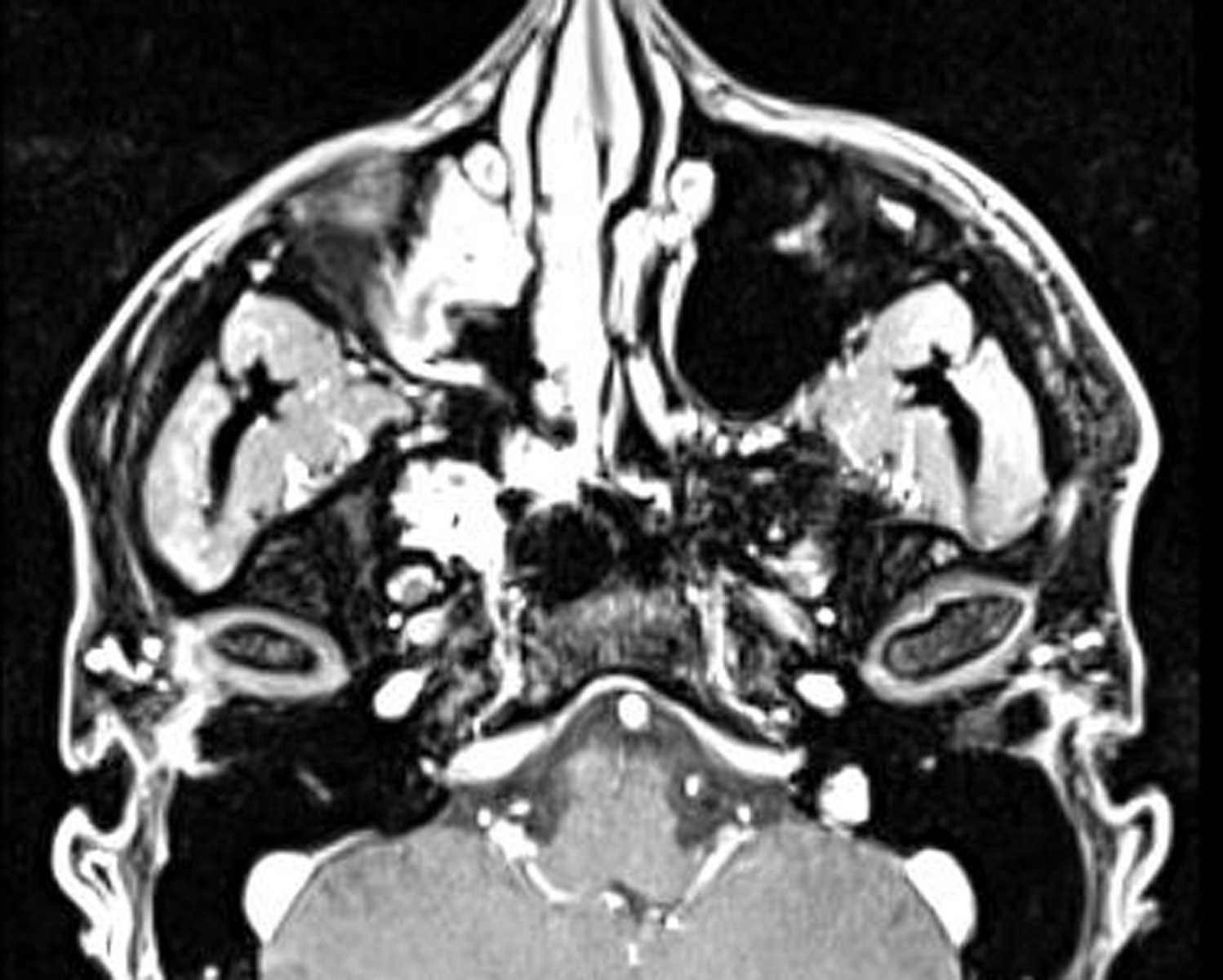 Juvenile Nasopharyngeal Angiofibroma - Neuro MR Case ...