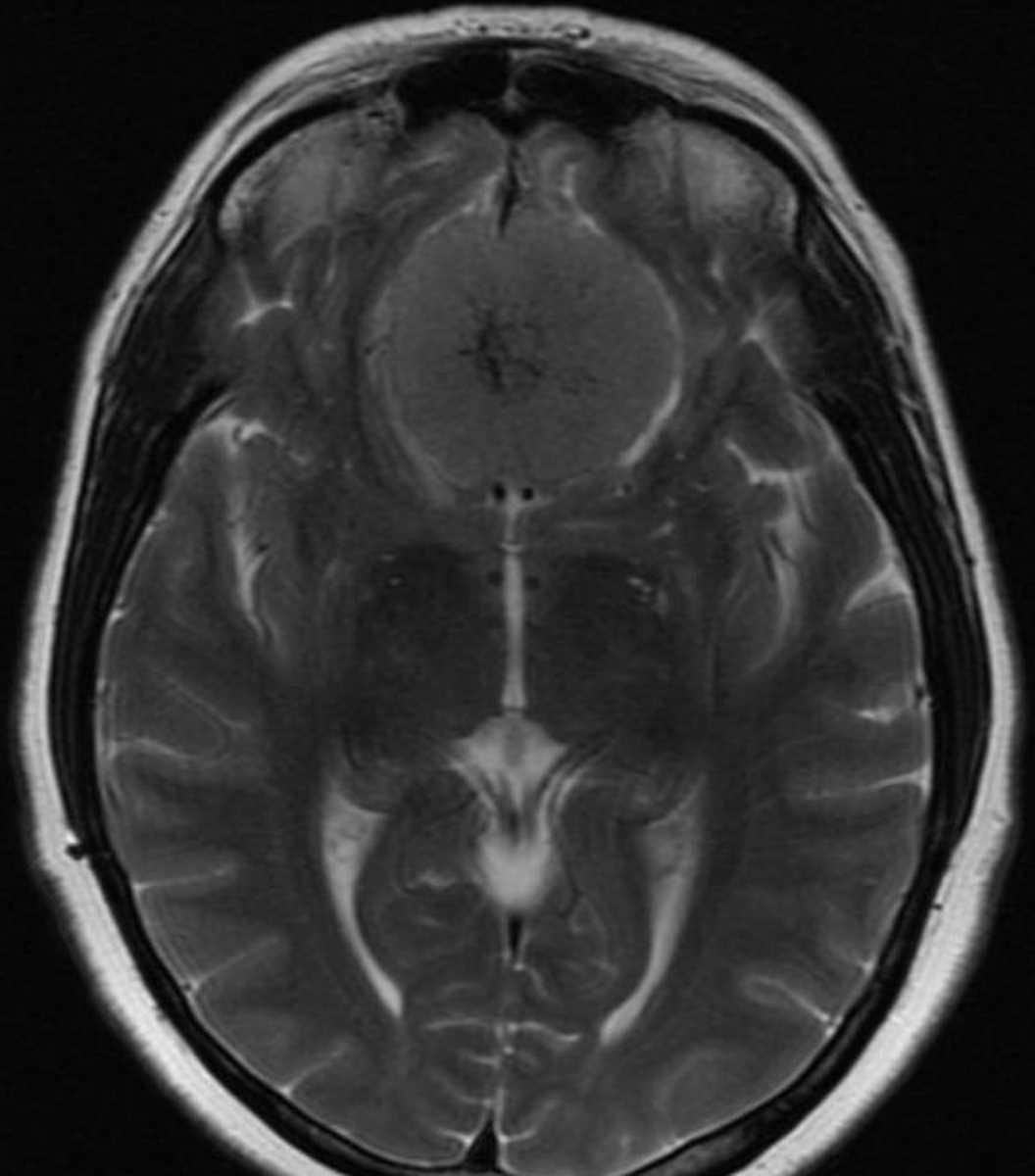 Meningioma (Planum Sphenoidale) - CTisus CT Scan