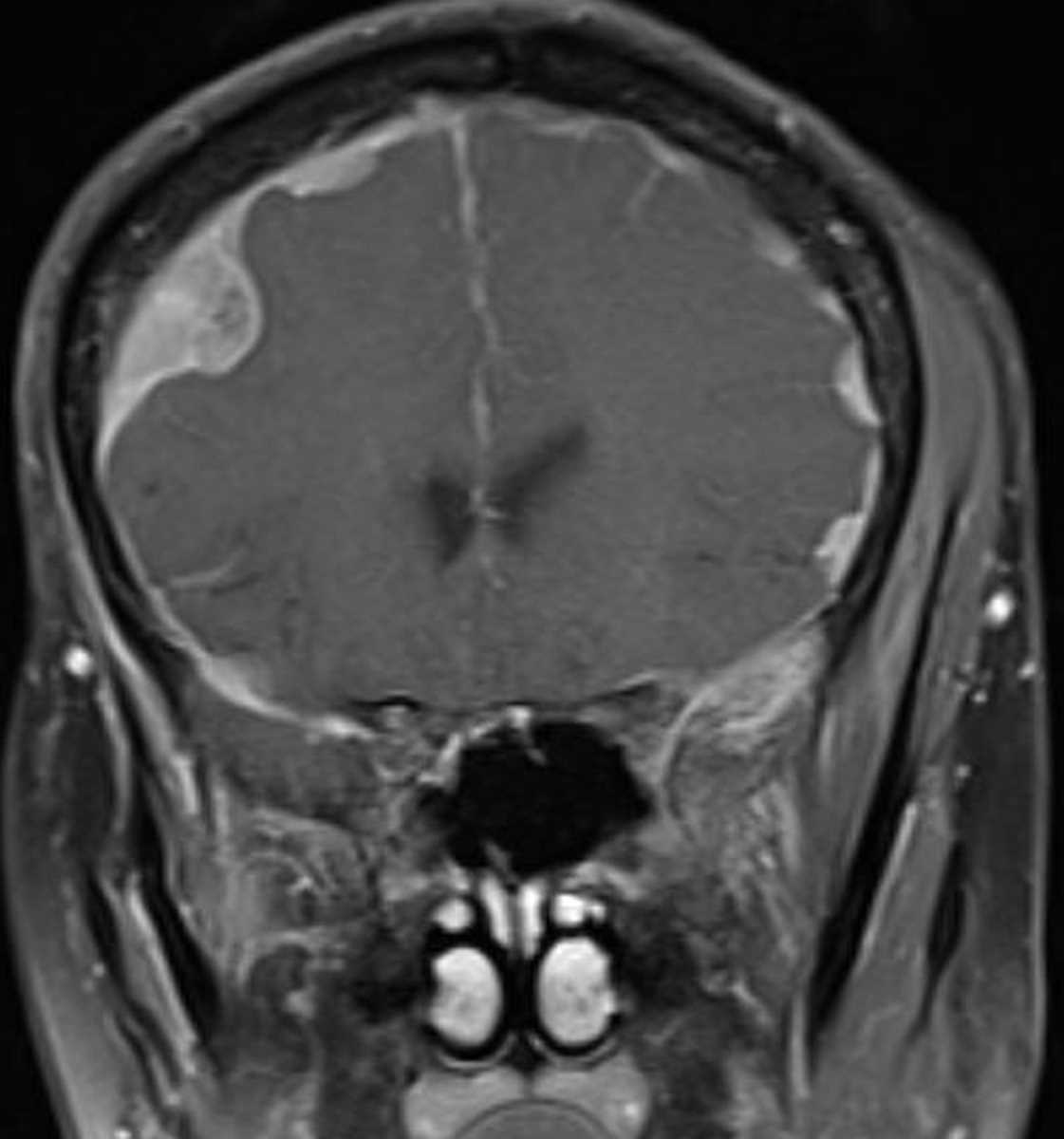 Neurofibromatosis II - CTisus CT Scan