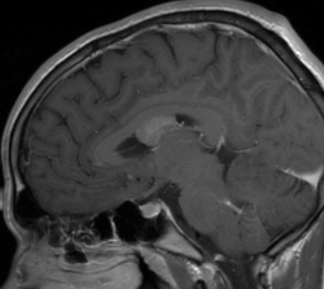 Central Neurocytoma - CTisus CT Scan