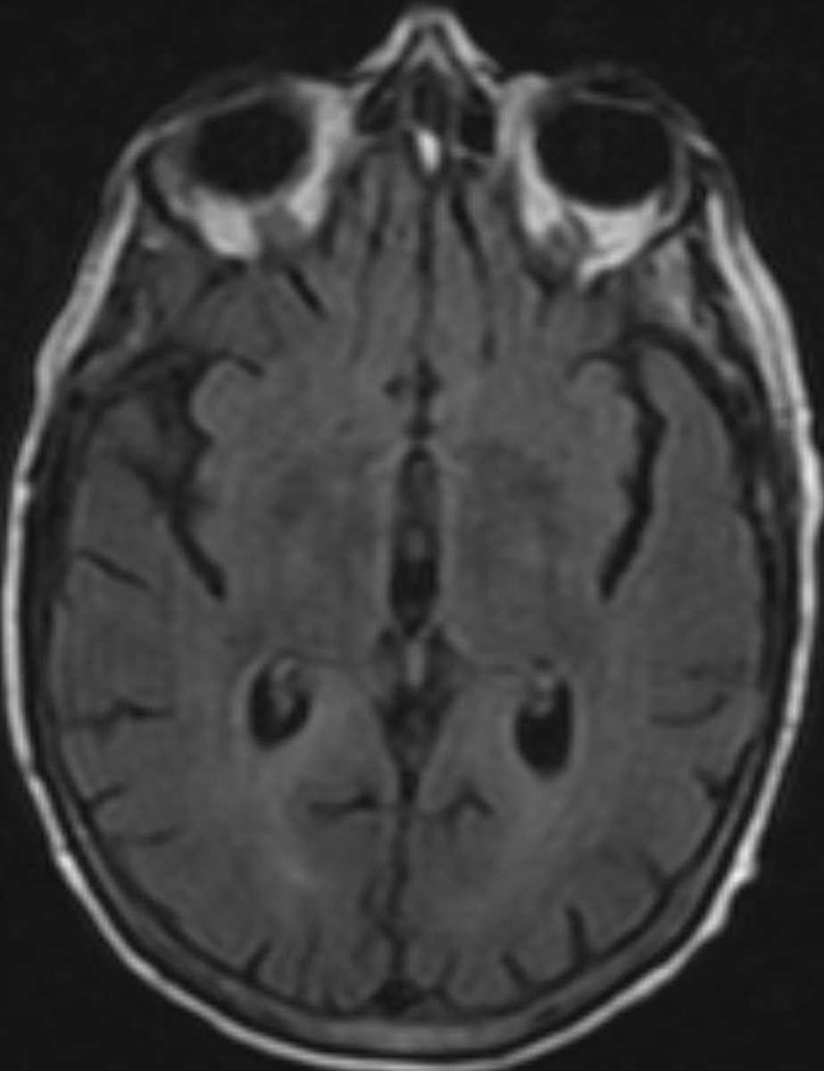Hepatic Encephalopathy - CTisus CT Scan