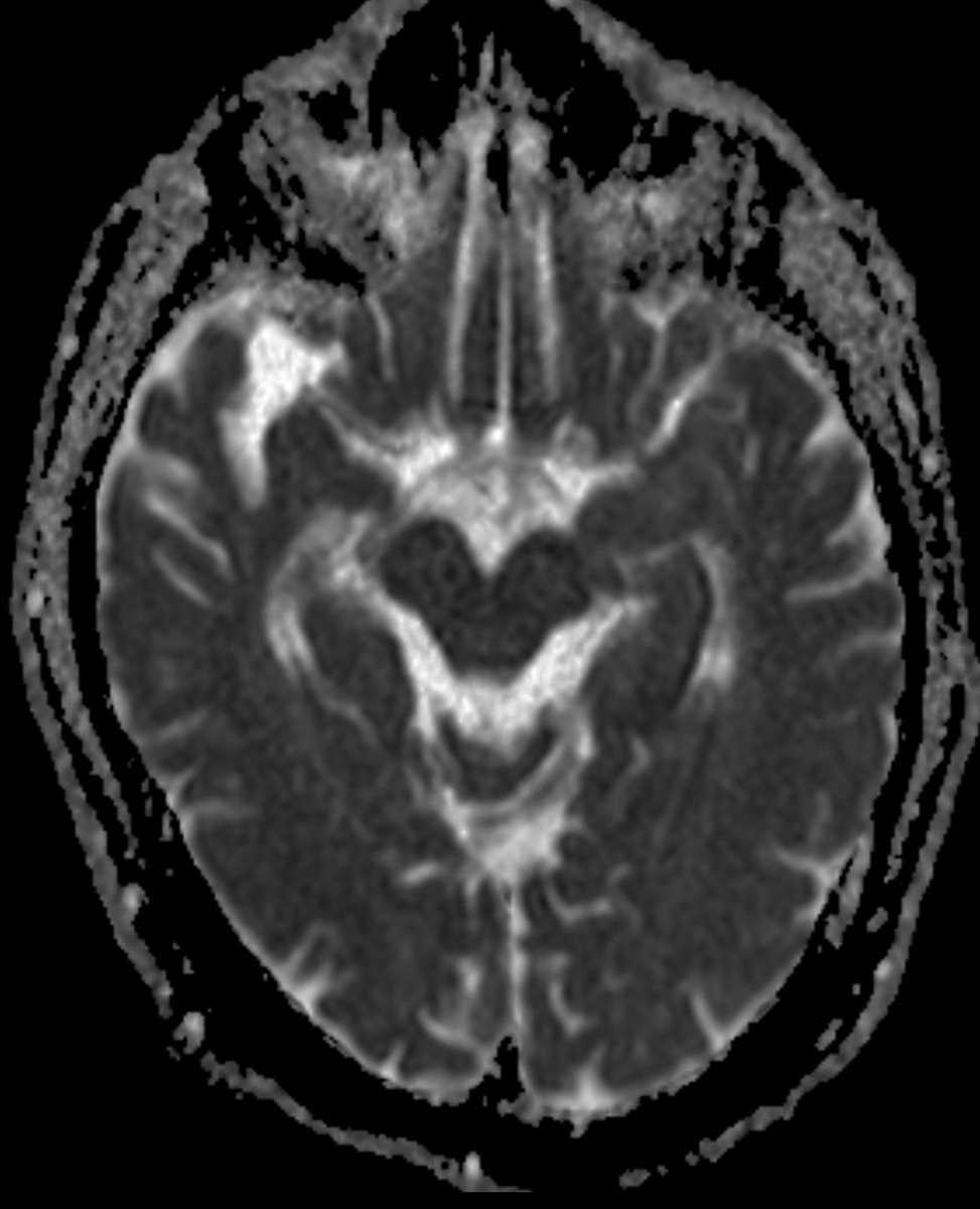 HSV Encephalitis - CTisus CT Scan