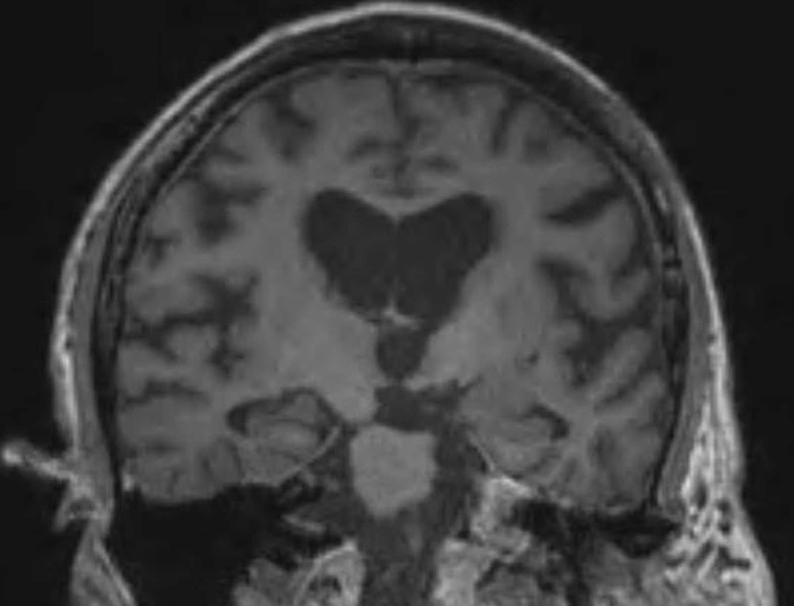 Mesial Temporal Sclerosis - CTisus CT Scan