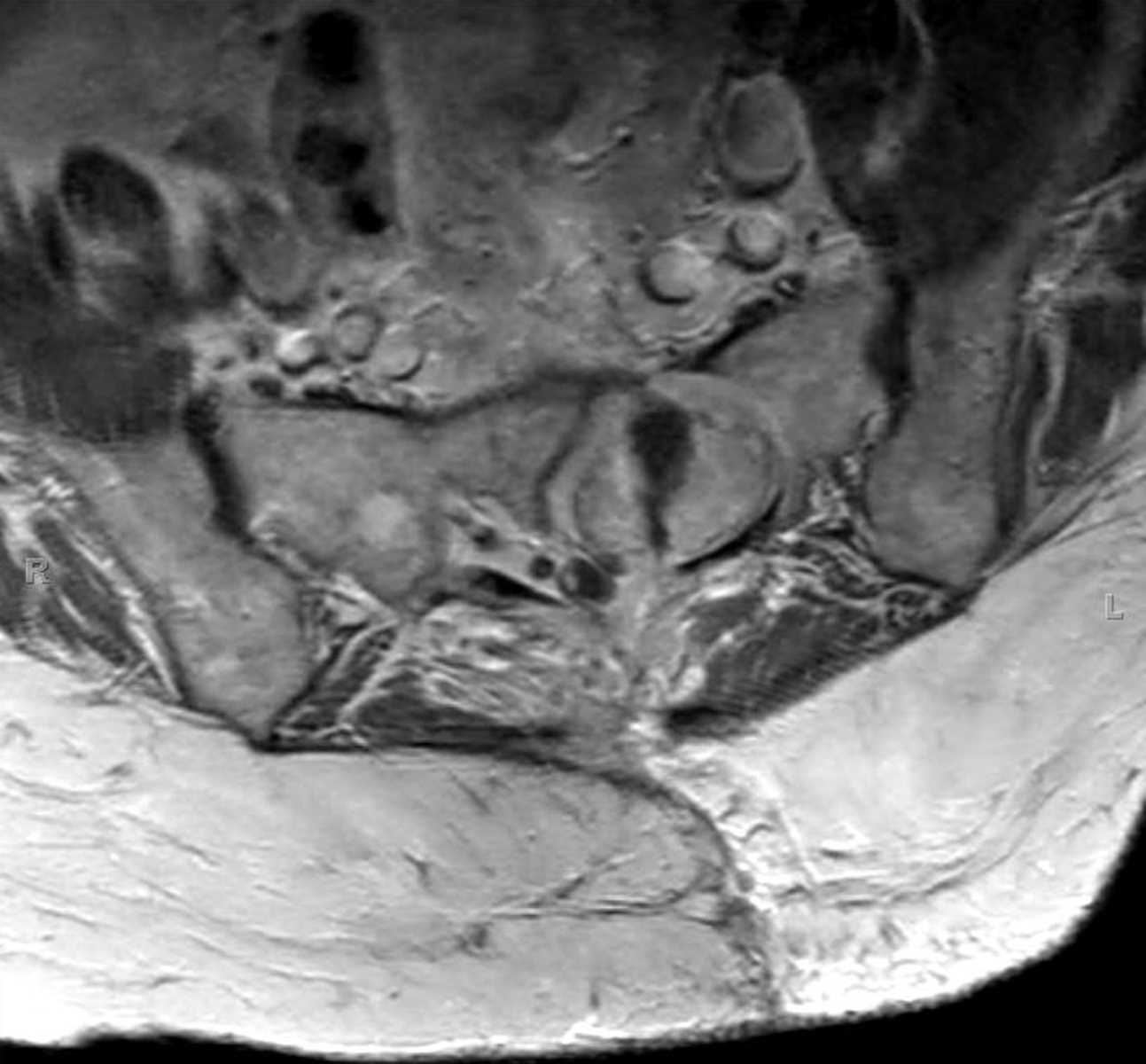 Myxopapillary Ependymoma - CTisus CT Scan