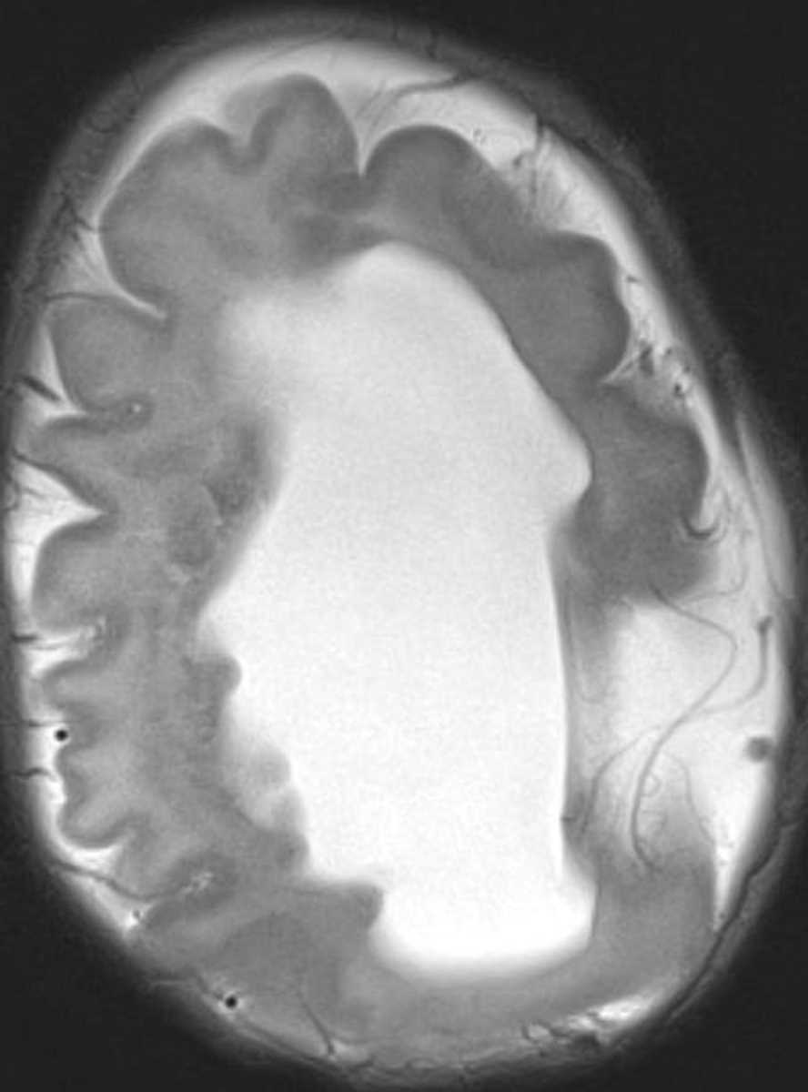 Holoprosencephaly - CTisus CT Scan