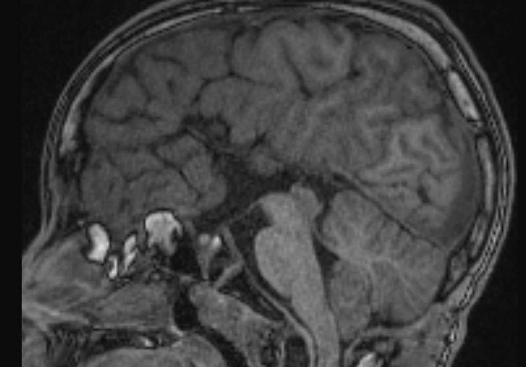 Persistent Craniopharyngeal Canal - CTisus CT Scan