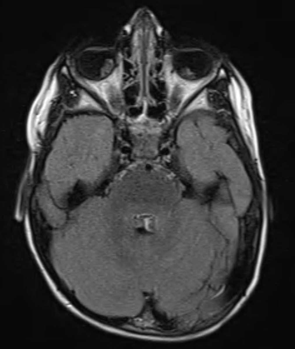 Retinoblastoma - CTisus CT Scan