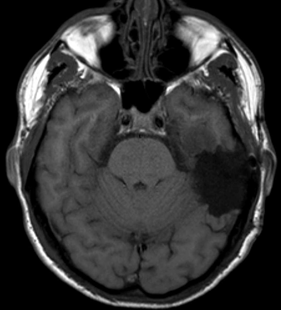 Oligodendroglioma (Recurrent) - CTisus CT Scan