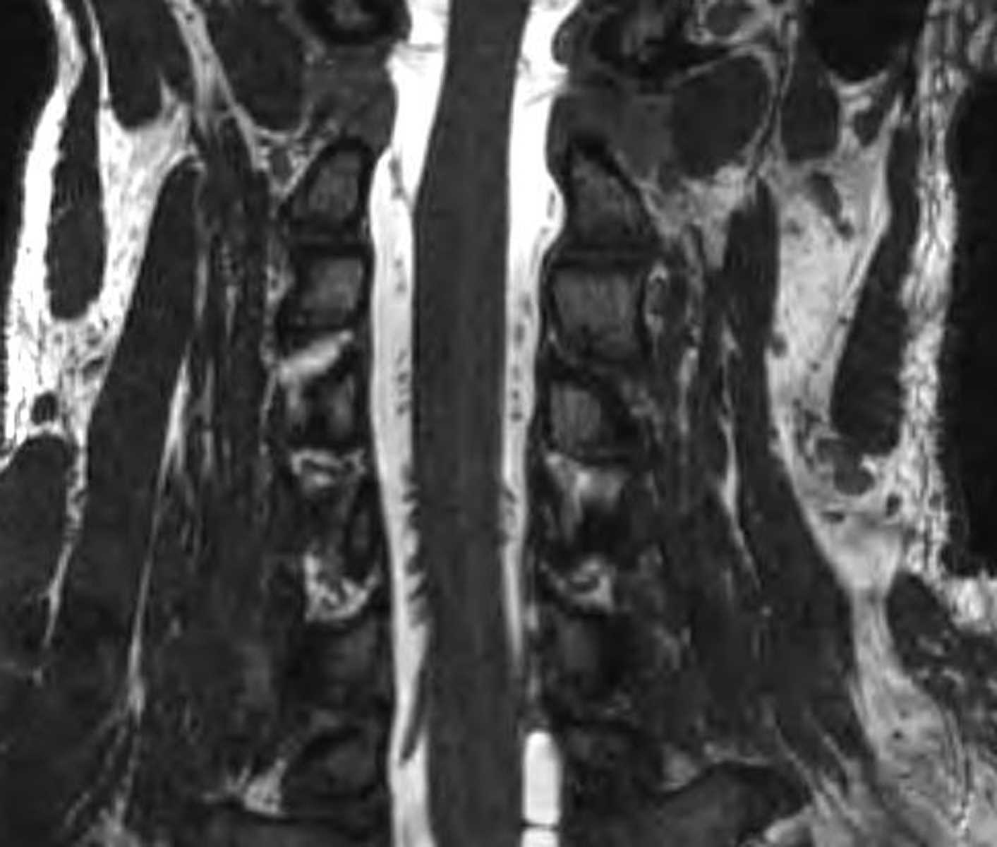 Pseudomeningocele (Spine) - CTisus CT Scan
