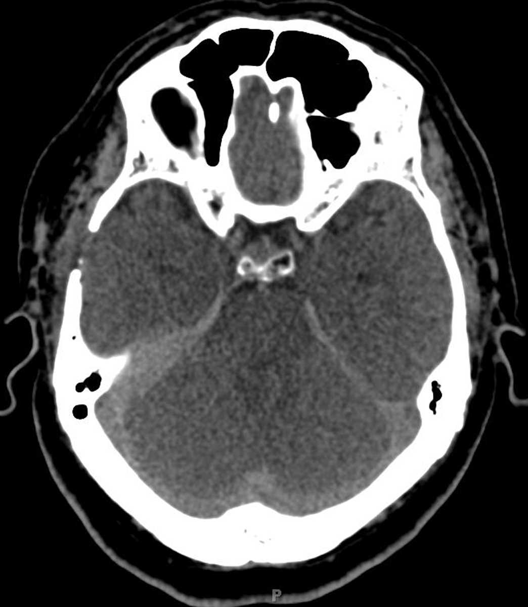 Rheumatoid Pachymeningitis - CTisus CT Scan
