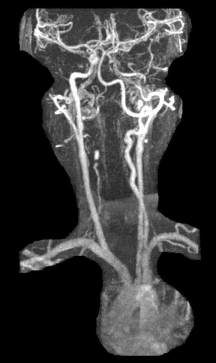 Carotid Dissection - CTisus CT Scan