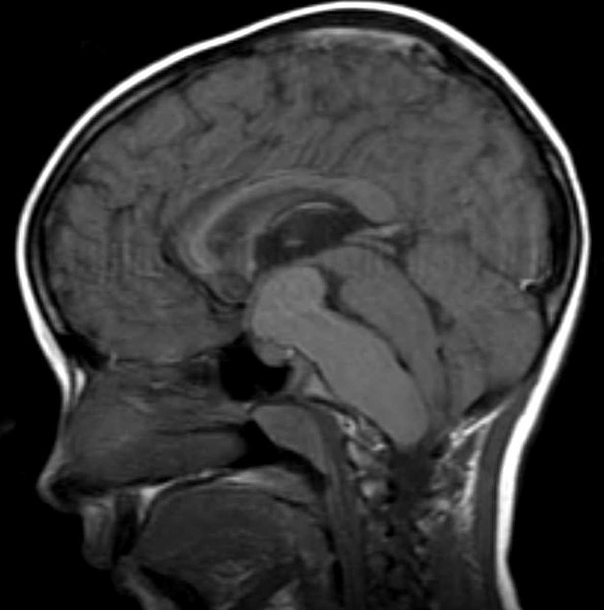 Craniopharyngioma - CTisus CT Scan