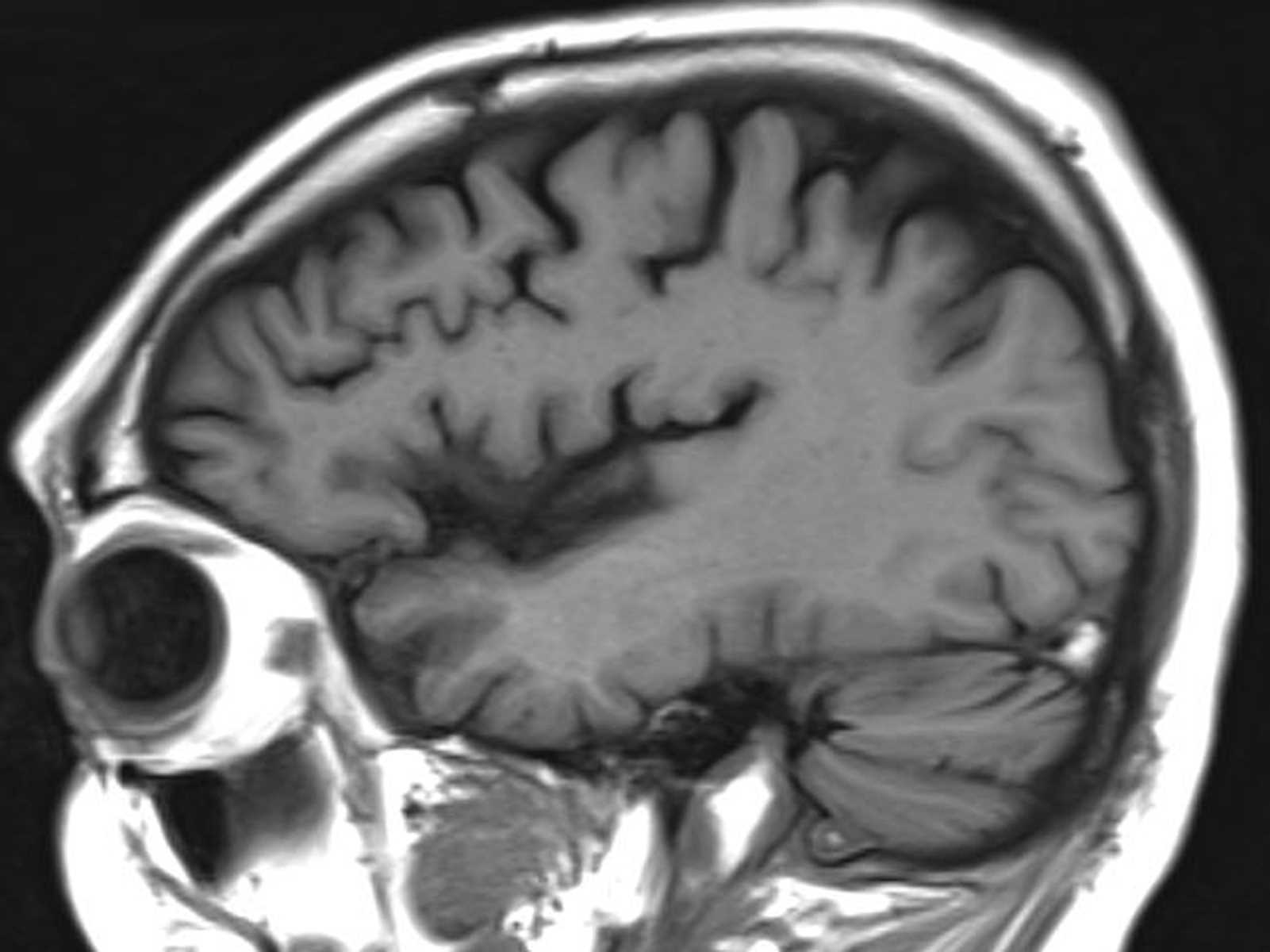 Dural Venous Sinus Thrombosis - CTisus CT Scan