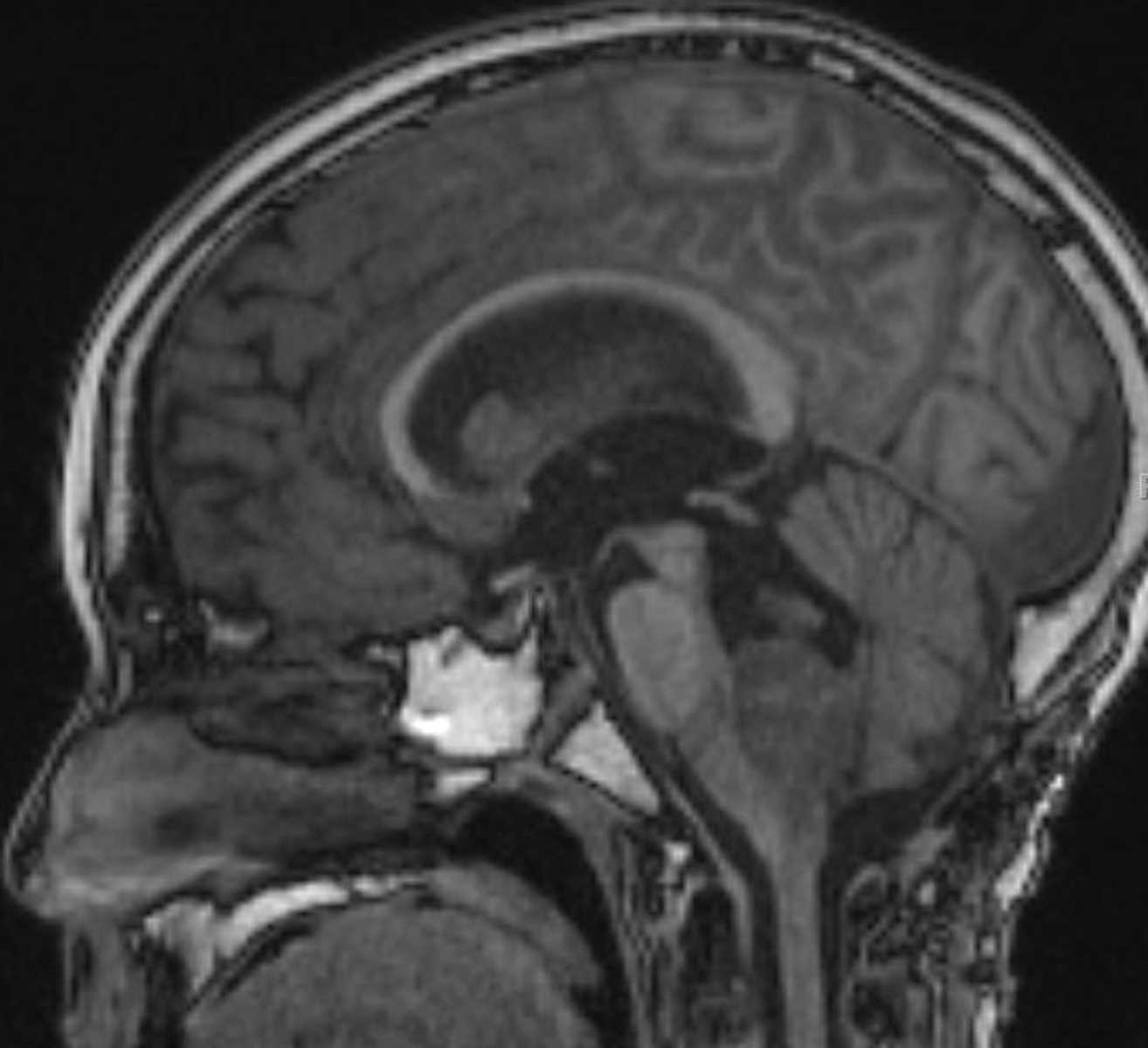 Ependymoma (Anaplastic) - CTisus CT Scan