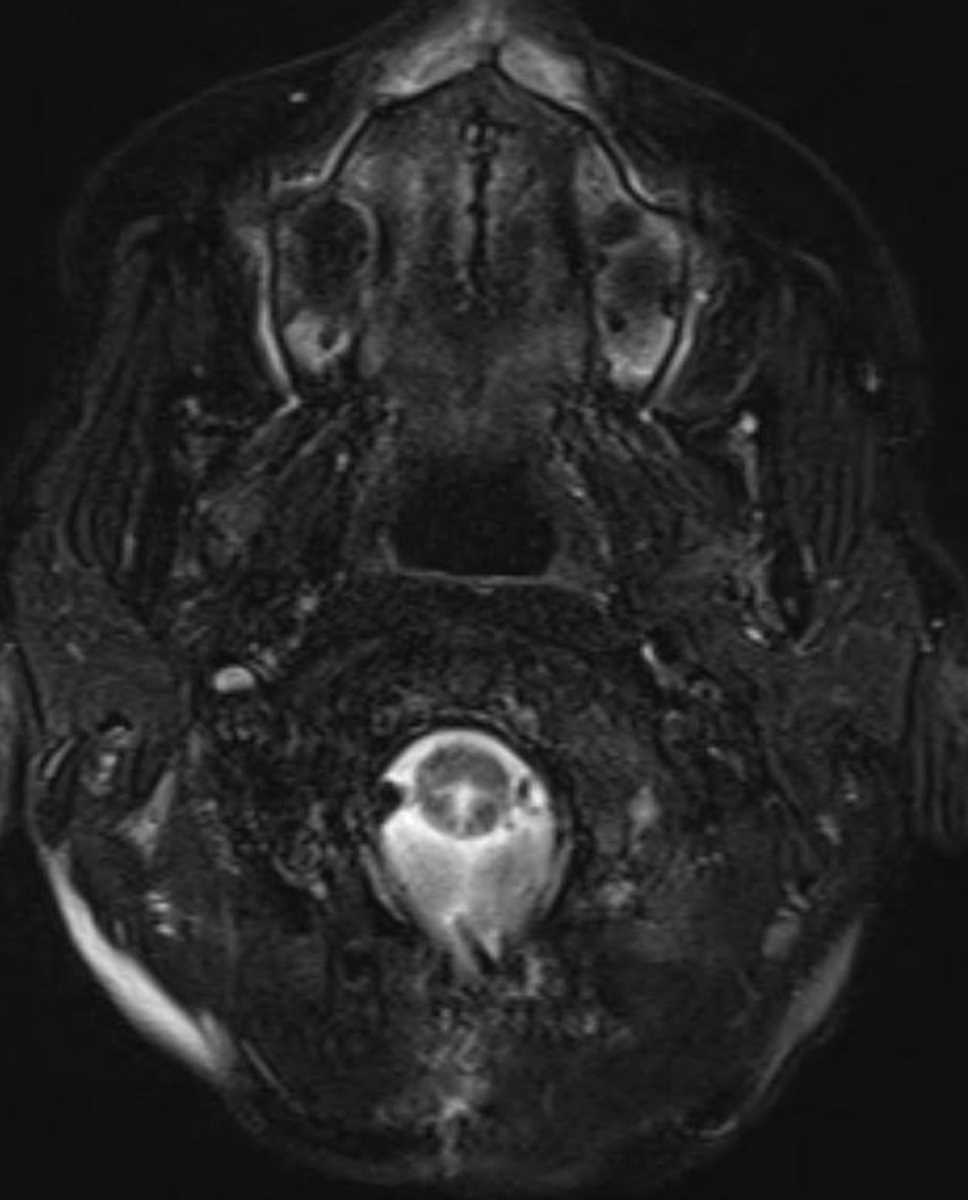 Fourth Ventricular Stent (Complications) - Neuro MR Case Studies ...