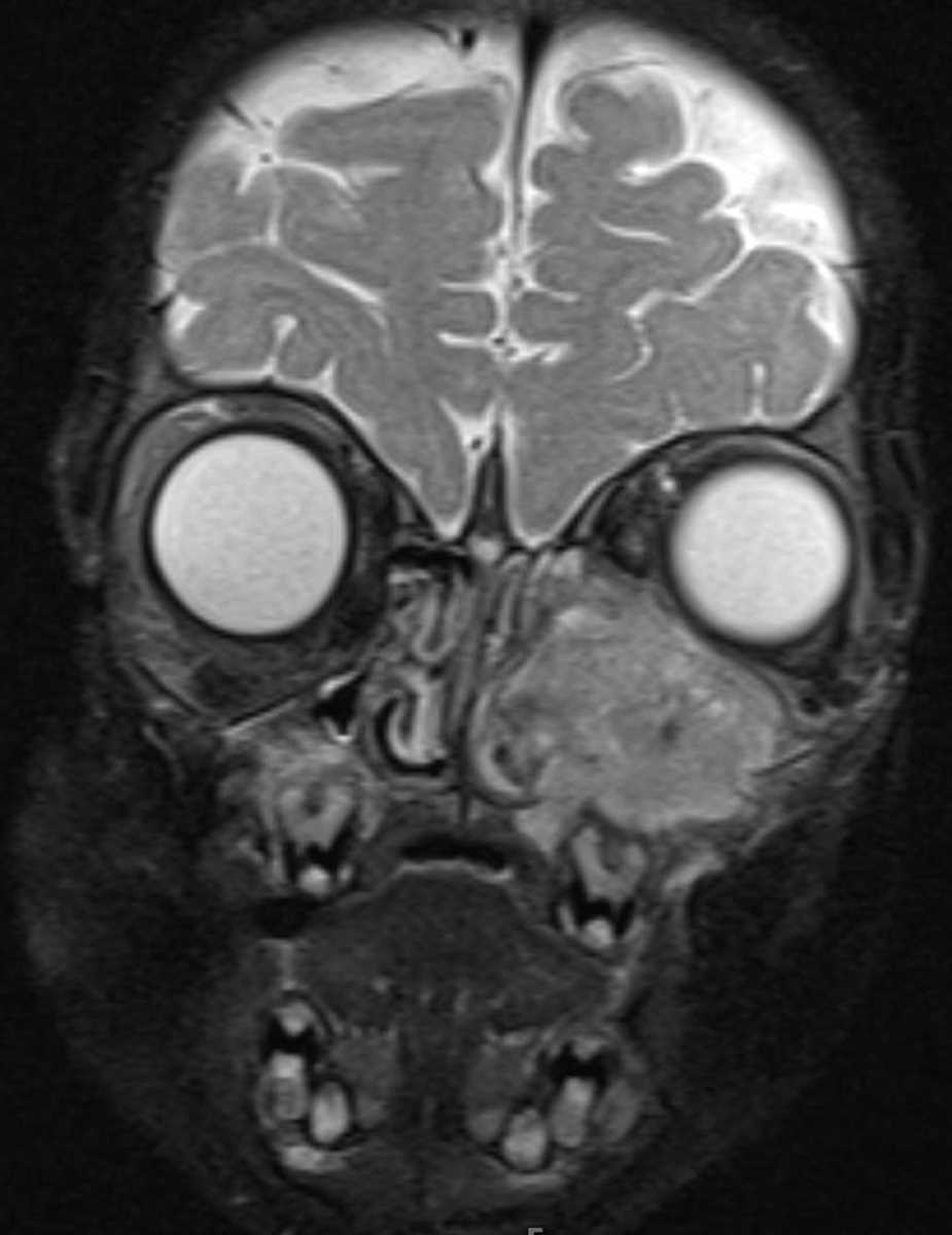 Langerhans Cell Histiocytosis - CTisus CT Scan