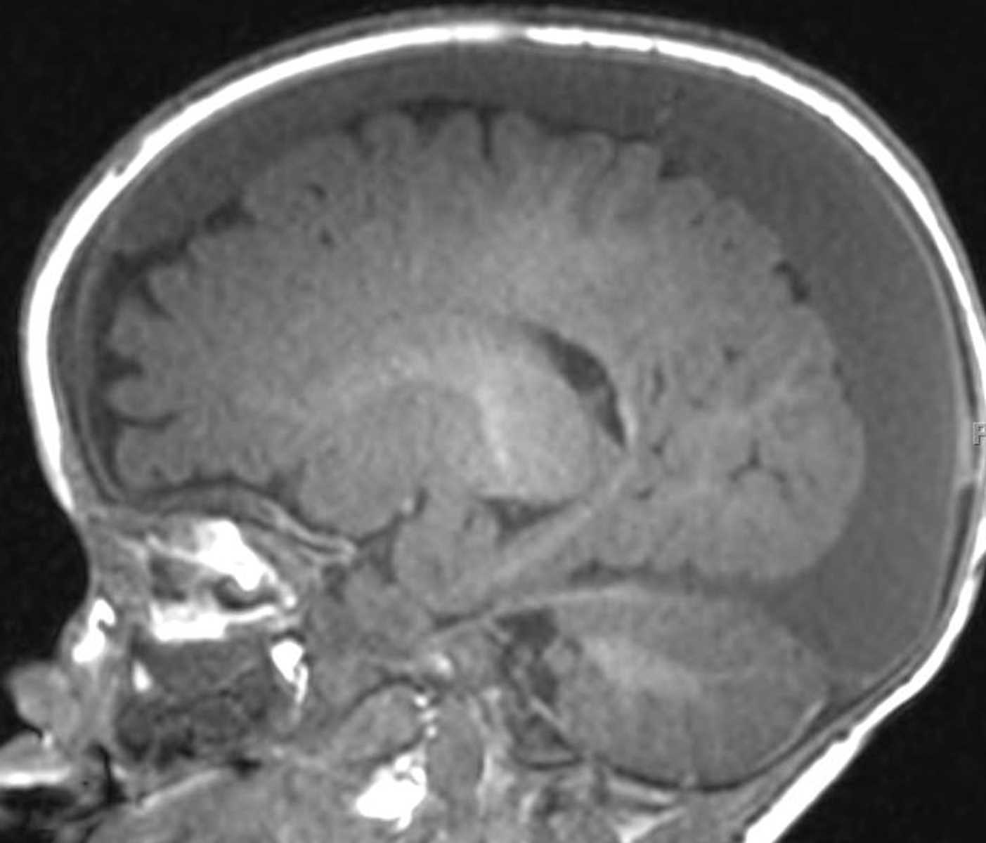 Nonaccidental Trauma - CTisus CT Scan