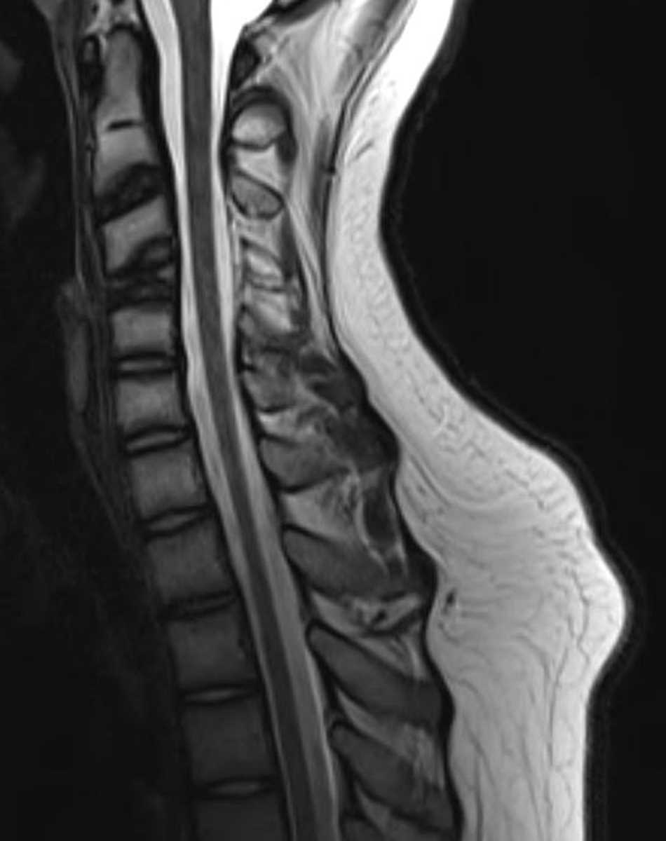 Vertebra Plana - CTisus CT Scan