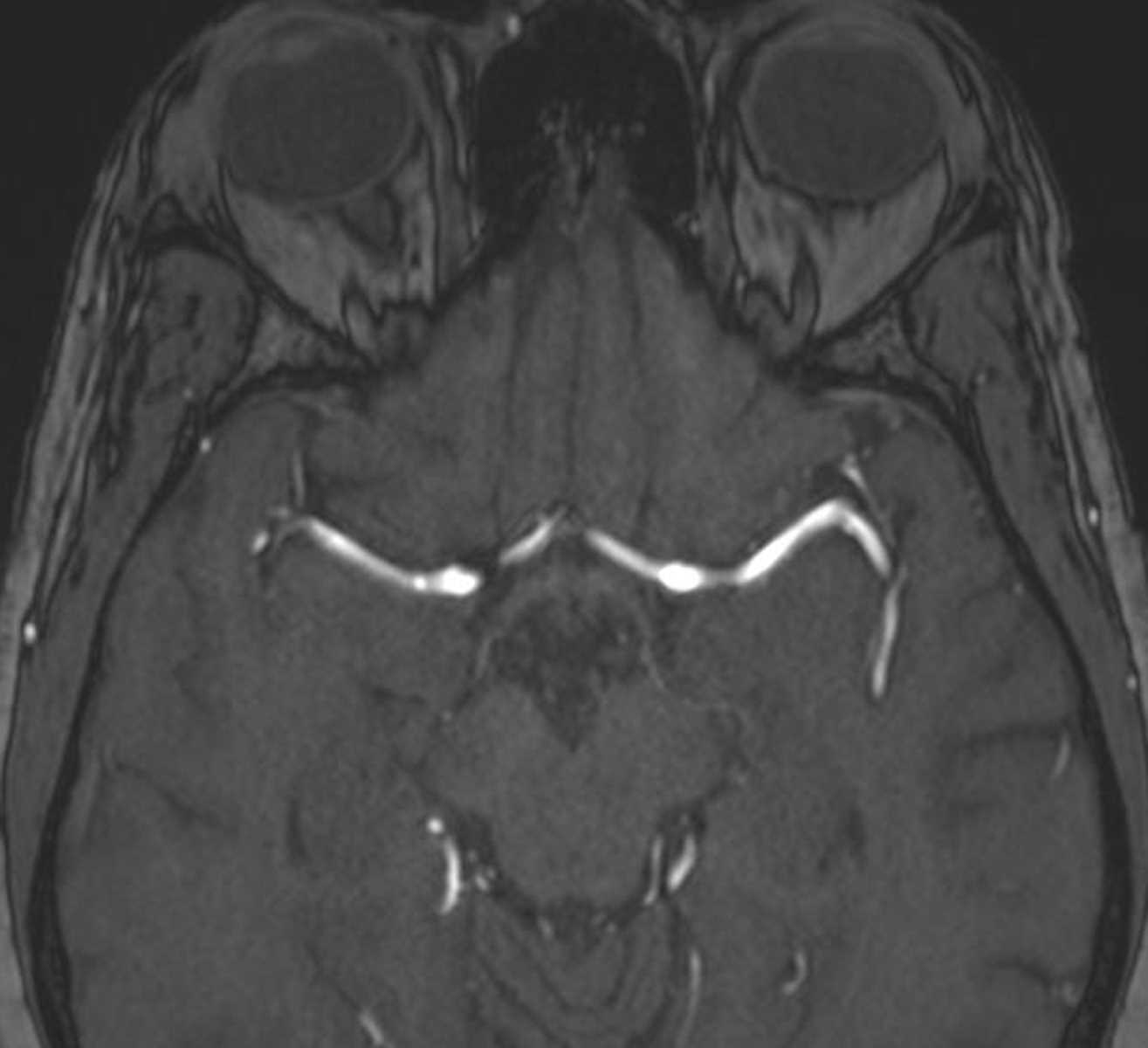 Aneurysm (MCA) - CTisus CT Scan