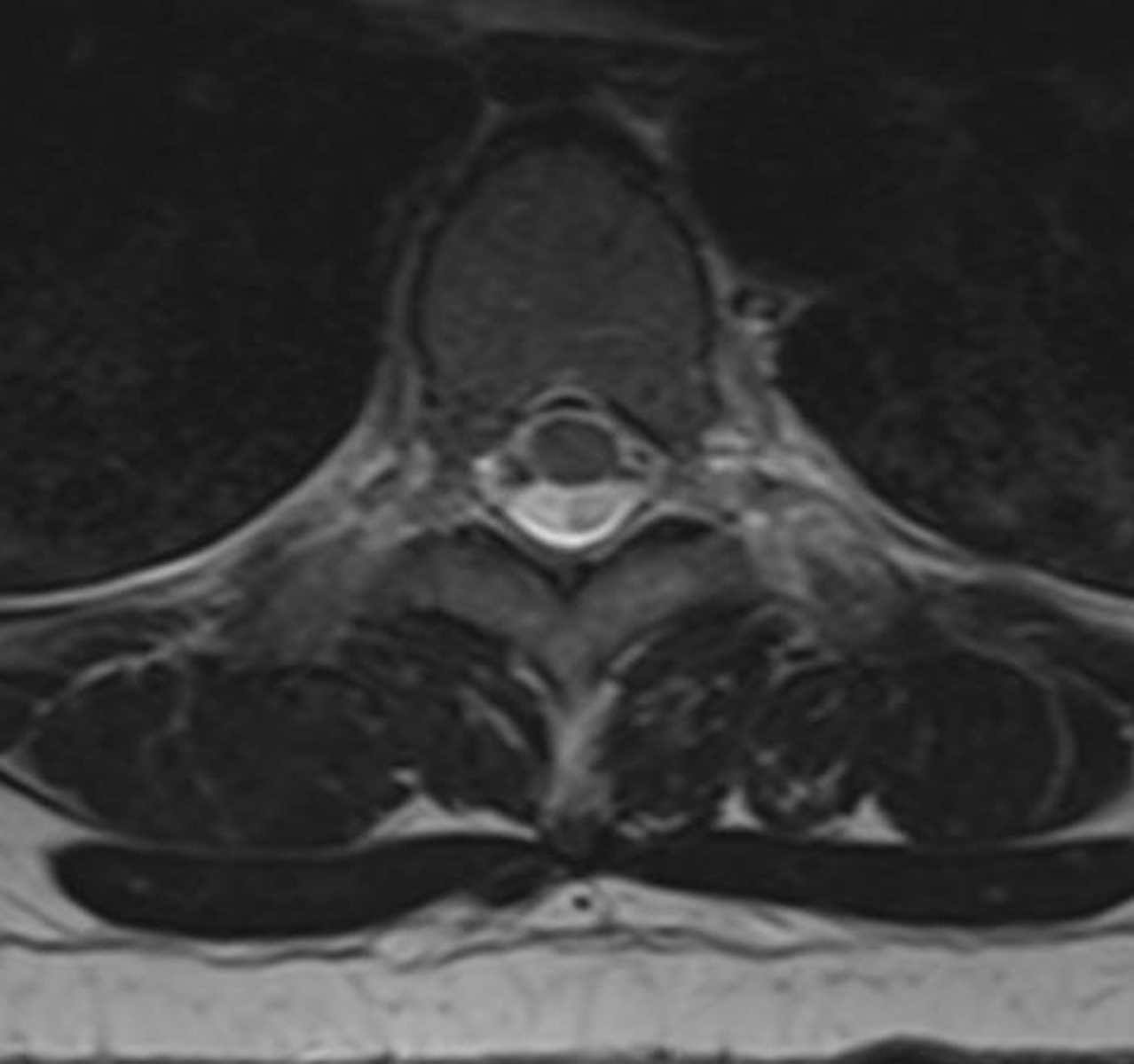 Arachnoid Cyst (Spinal) - CTisus CT Scan