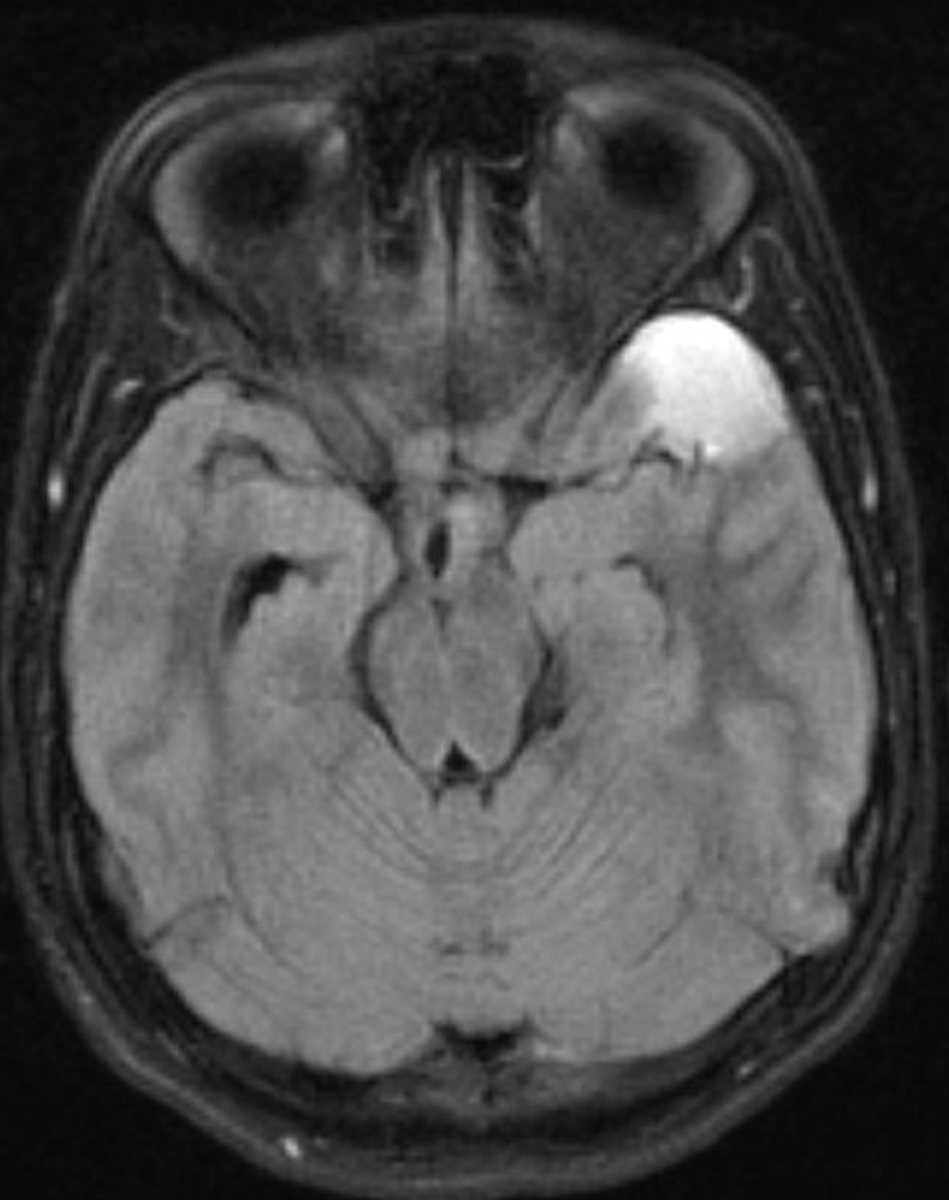 Arachnoid Cyst (Subdural Hematoma) - CTisus CT Scan