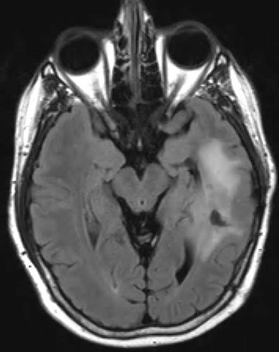 Astrocytoma (Temporal Lobe) - CTisus CT Scan