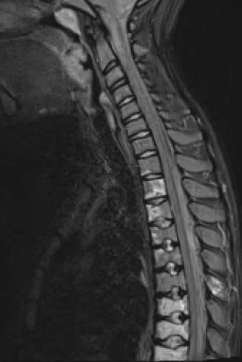 Bone Infarct (Spine) - Neuro MR Case Studies - CTisus CT Scanning