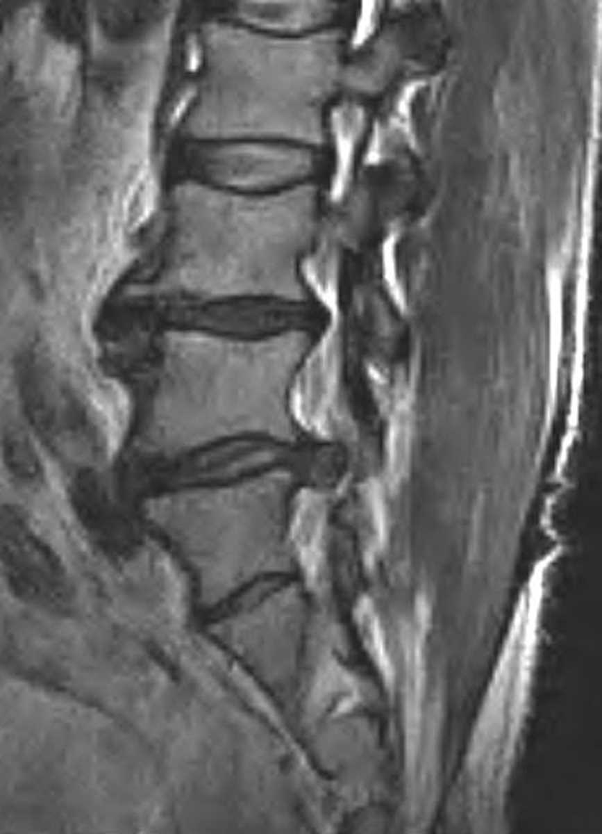 Disc Extrusion - CTisus CT Scan