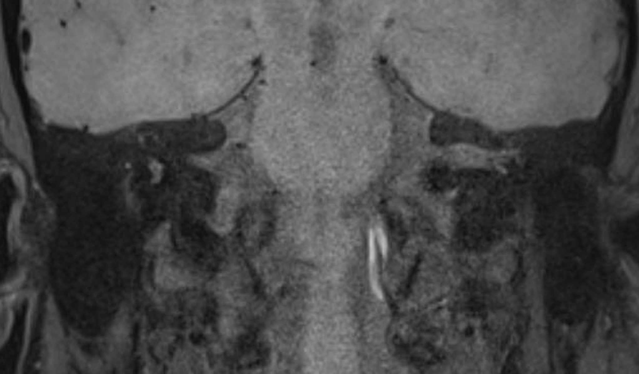 Dissection (Vertebral Artery) - CTisus CT Scan