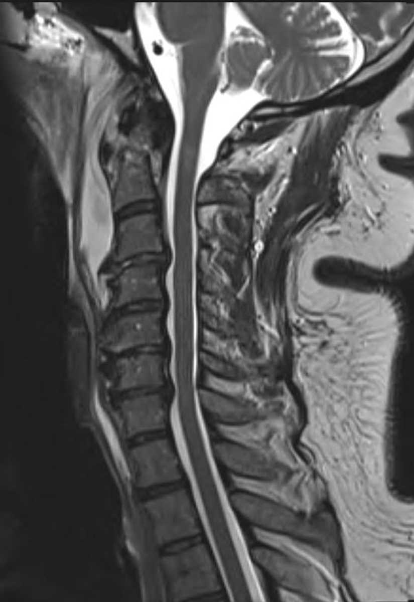 Fracture (Odontoid) - CTisus CT Scan