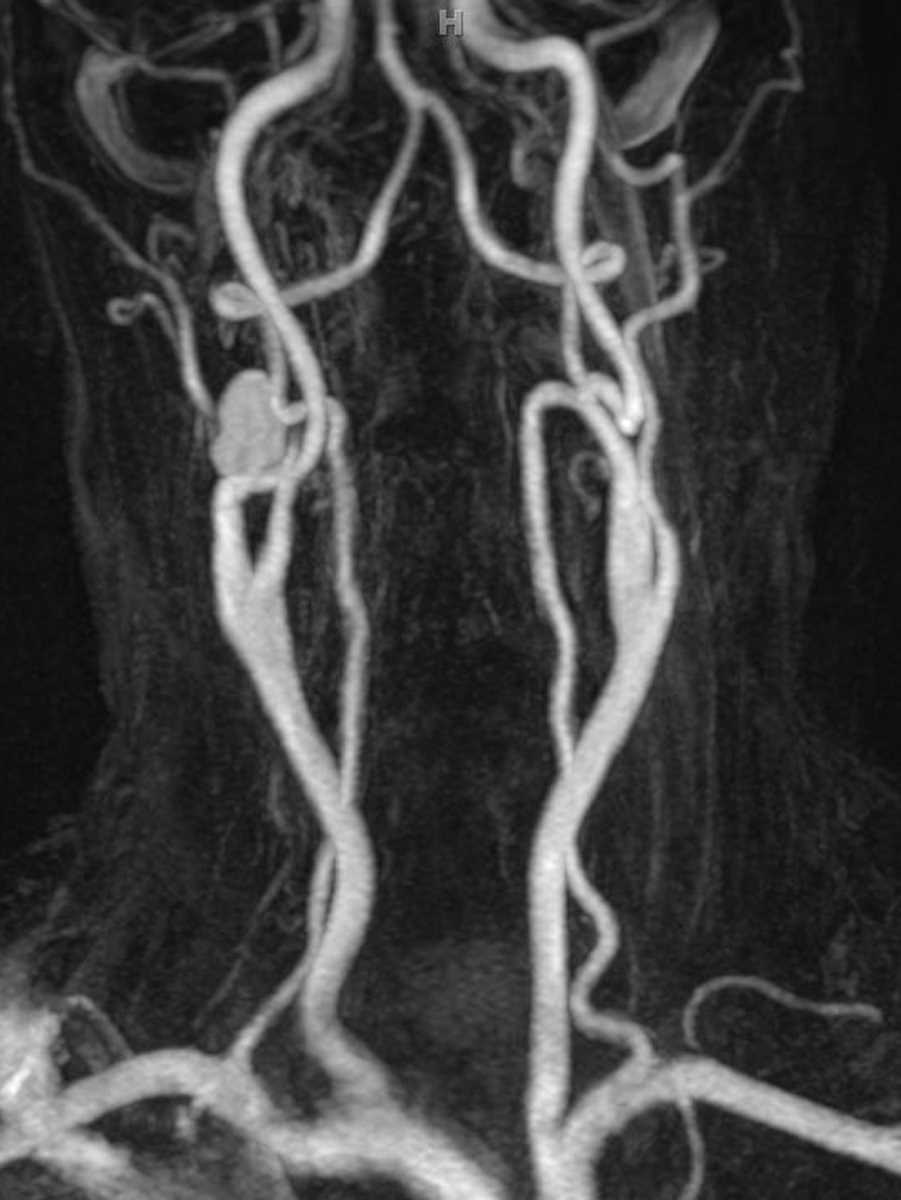 Pseudoaneurysm (Internal Carotid Artery) - CTisus CT Scan