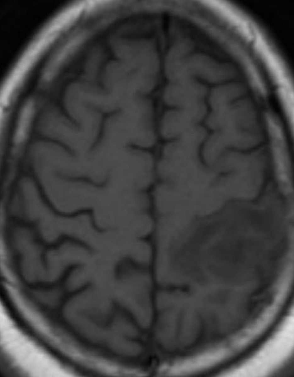 Abscess (Cerebral) - CTisus CT Scan