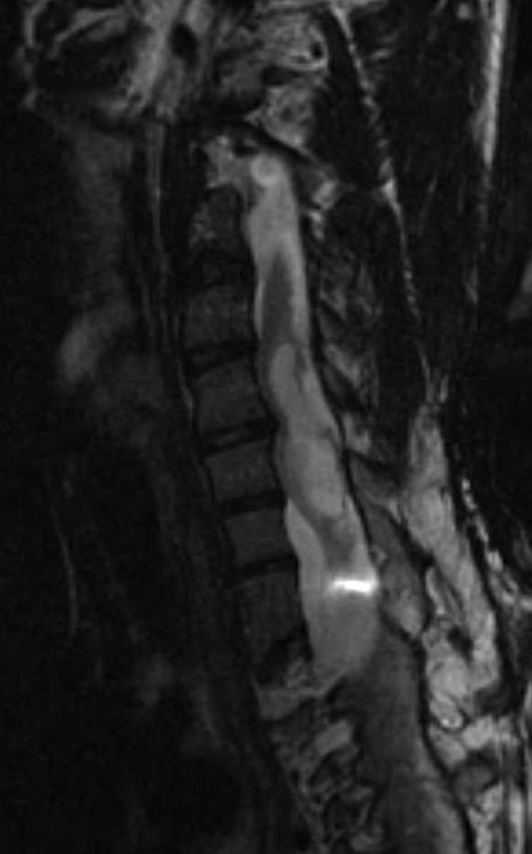 Astrocytoma (Spinal) - CTisus CT Scan
