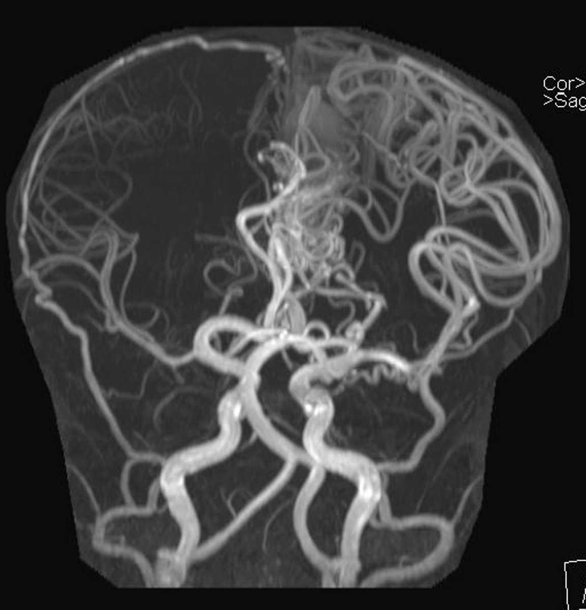 Arteriovenous Malformation - CTisus CT Scan