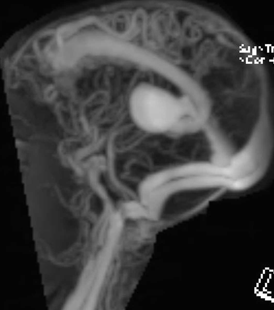 Arteriovenous Malformation - CTisus CT Scan