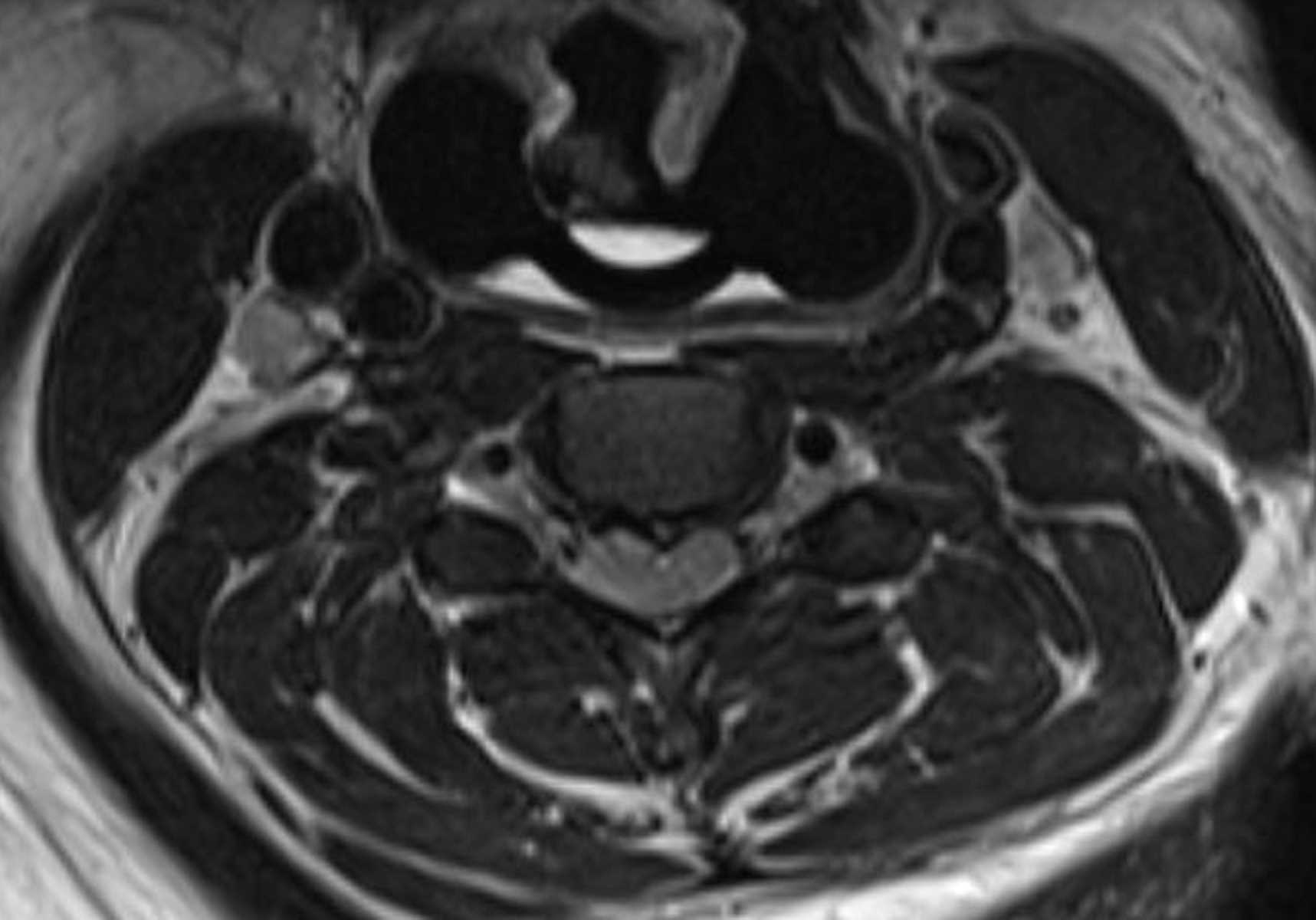 Compressive Myelopathy - CTisus CT Scan