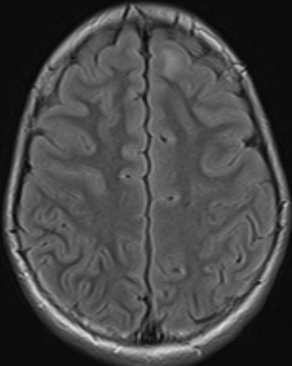 Focal Cortical Dysplasia - CTisus CT Scan