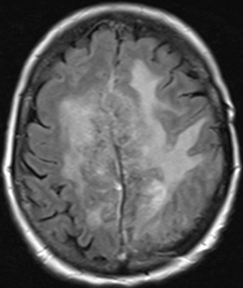 Meningioma (Atypical) - CTisus CT Scan