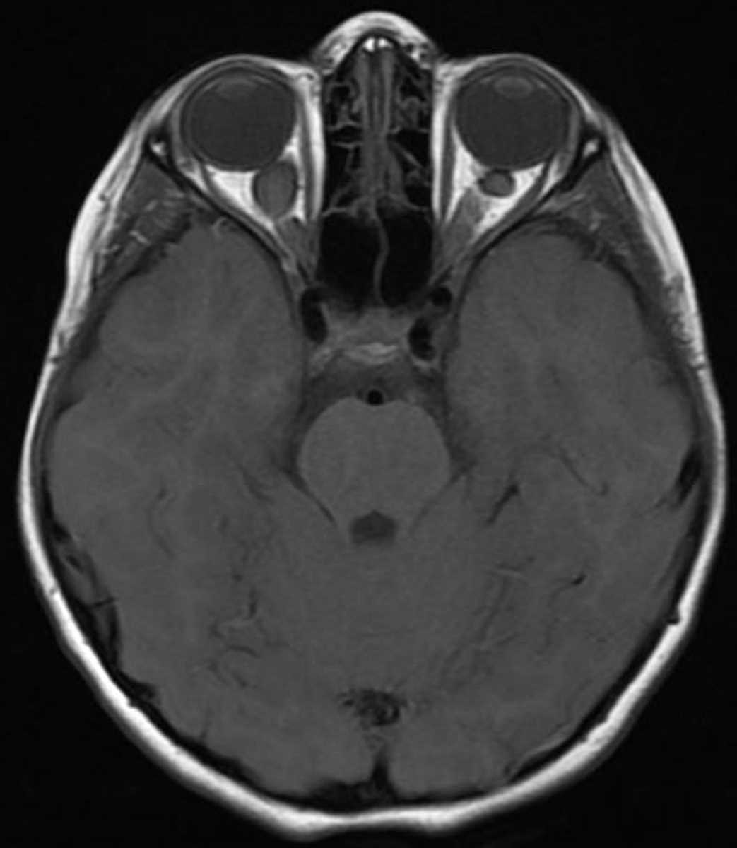 Optic Glioma - CTisus CT Scan