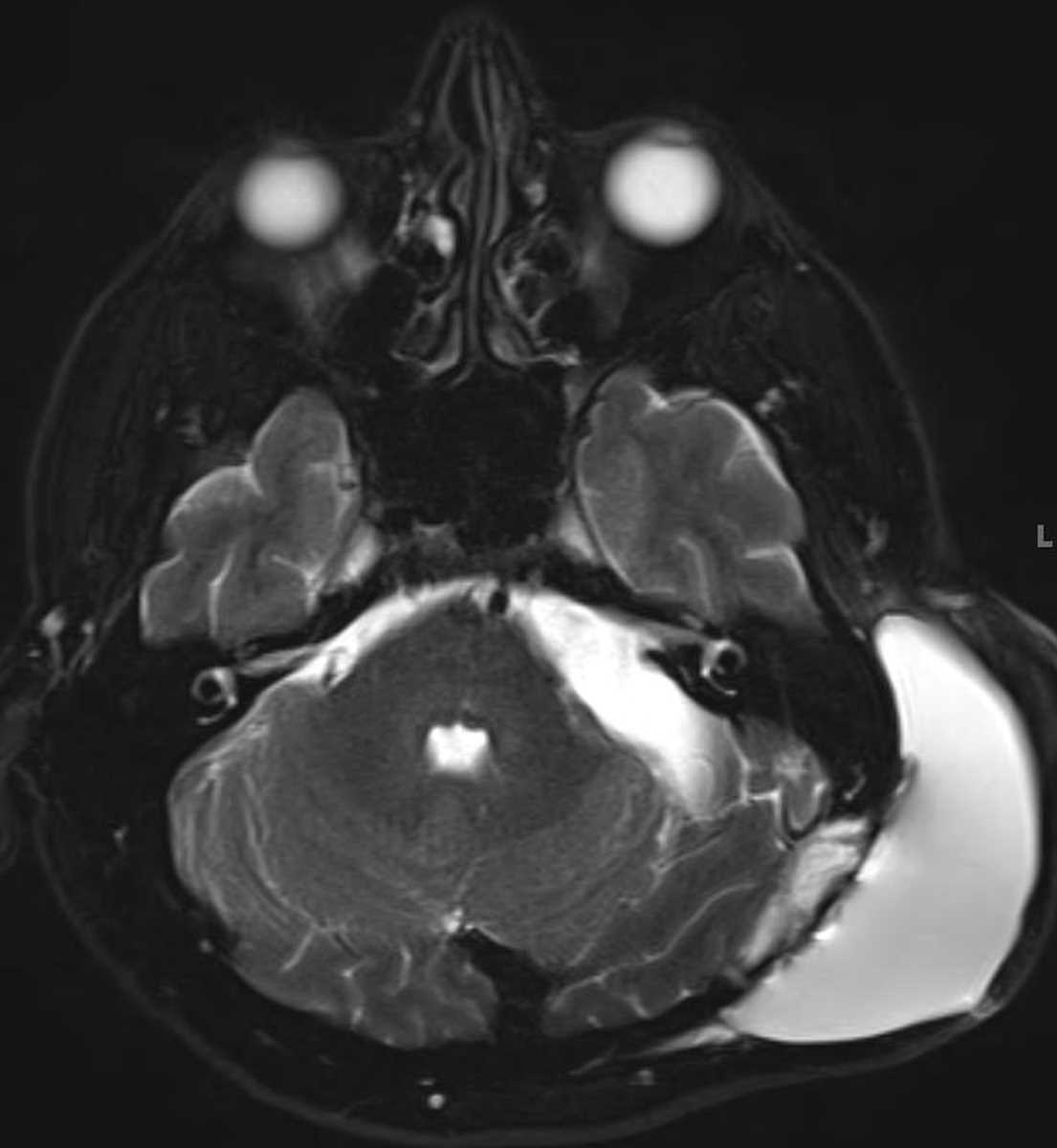 Pseudomeningocele - CTisus CT Scan