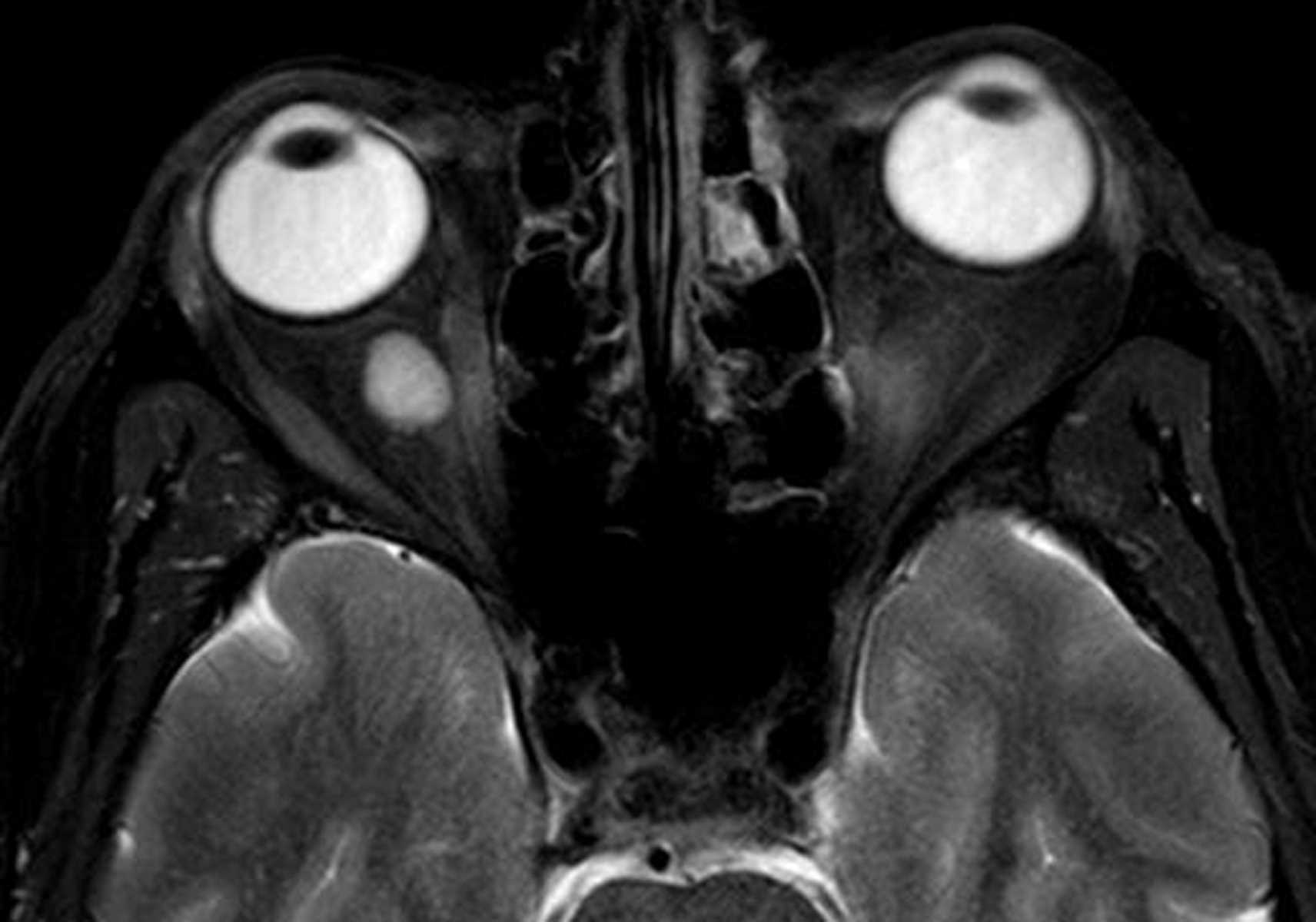 Hemangioma (Orbit) - CTisus CT Scan