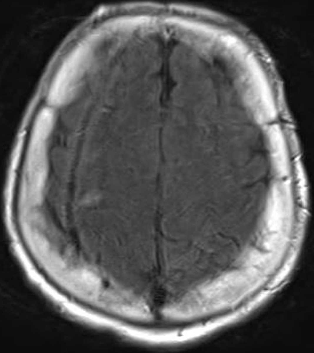 Infarction- Right MCA - CTisus CT Scan