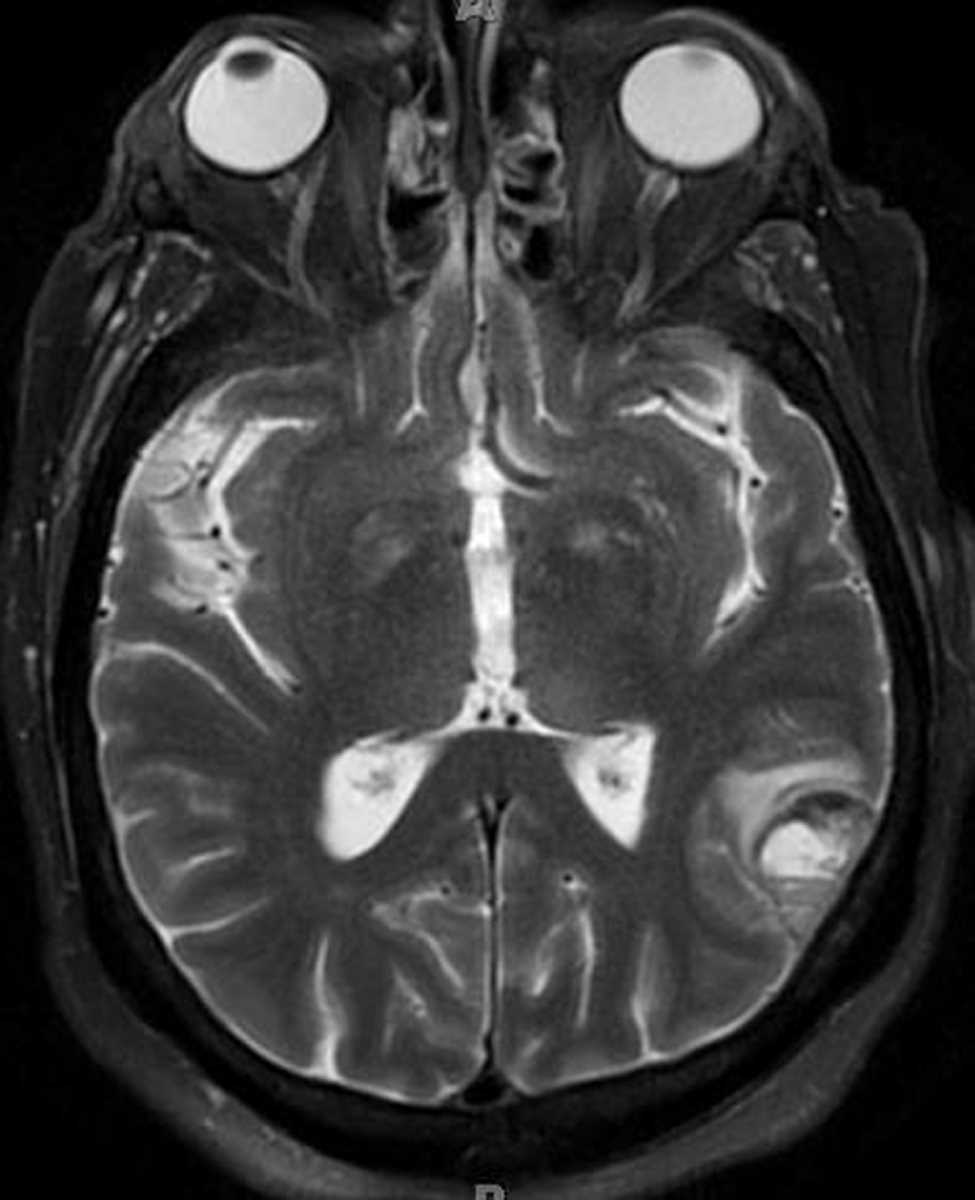 Metastases-Prostate Cancer - CTisus CT Scan