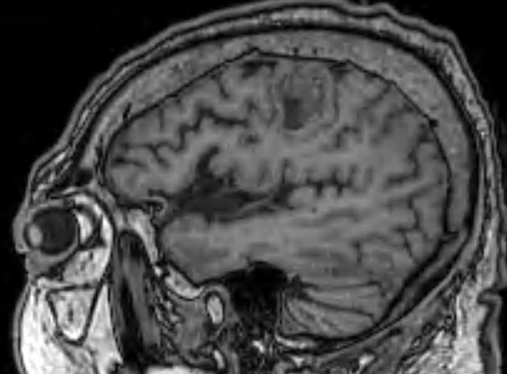 Amyloid Angiopathy - CTisus CT Scan