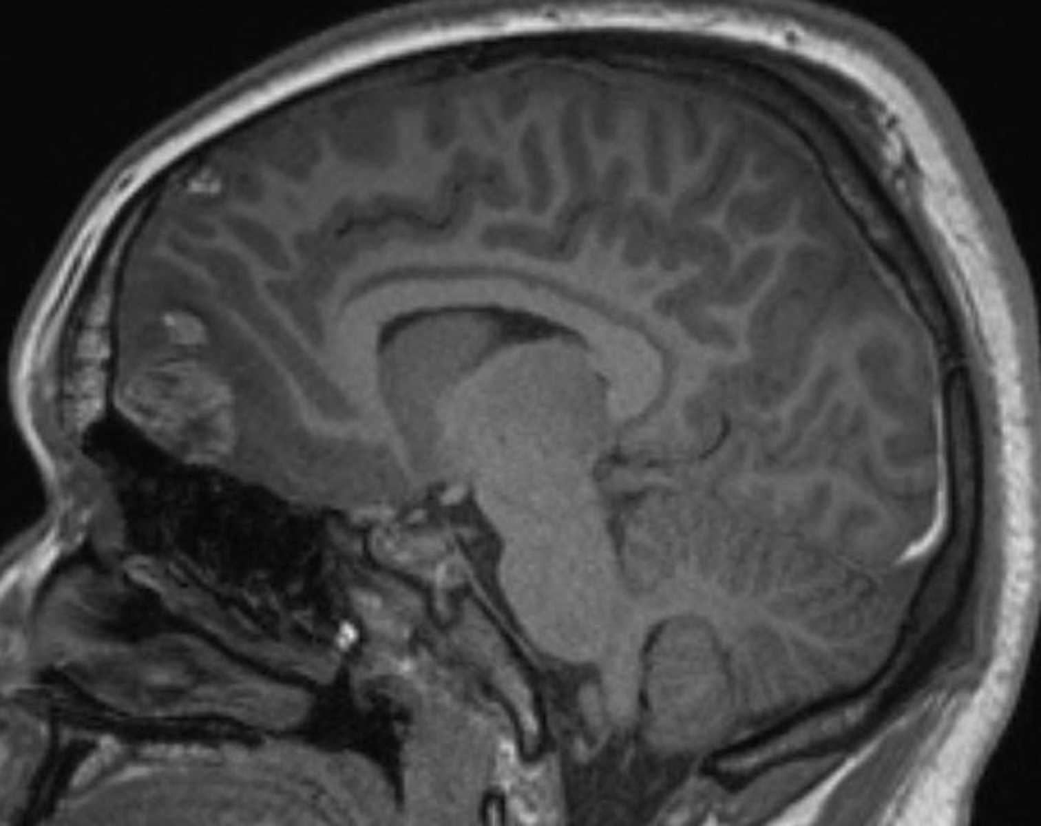 Brain Contusions - CTisus CT Scan