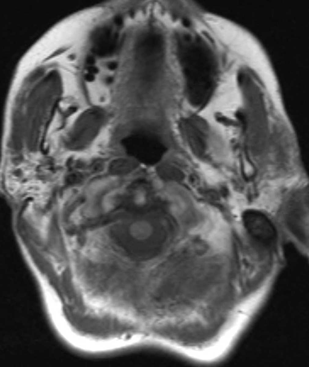 Sjogren's Syndrome - CTisus CT Scan